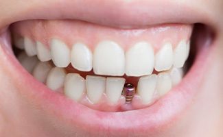 Dental implant post in gum