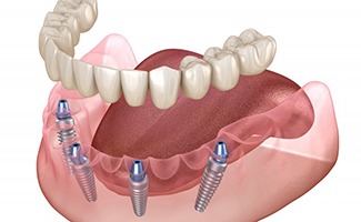 a 3D illustration of All-On-4 implants