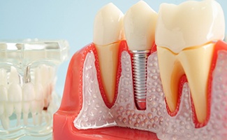 a model of a dental implant in the jawbone