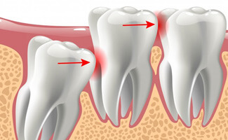 Illustration of impacted tooth