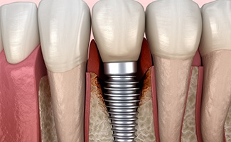 Illustration of bone loss around failed dental implant