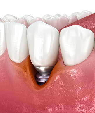 Illustration of bone loss around failed dental implant