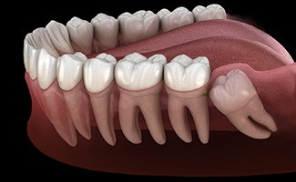 Digital illustration of an impacted wisdom tooth