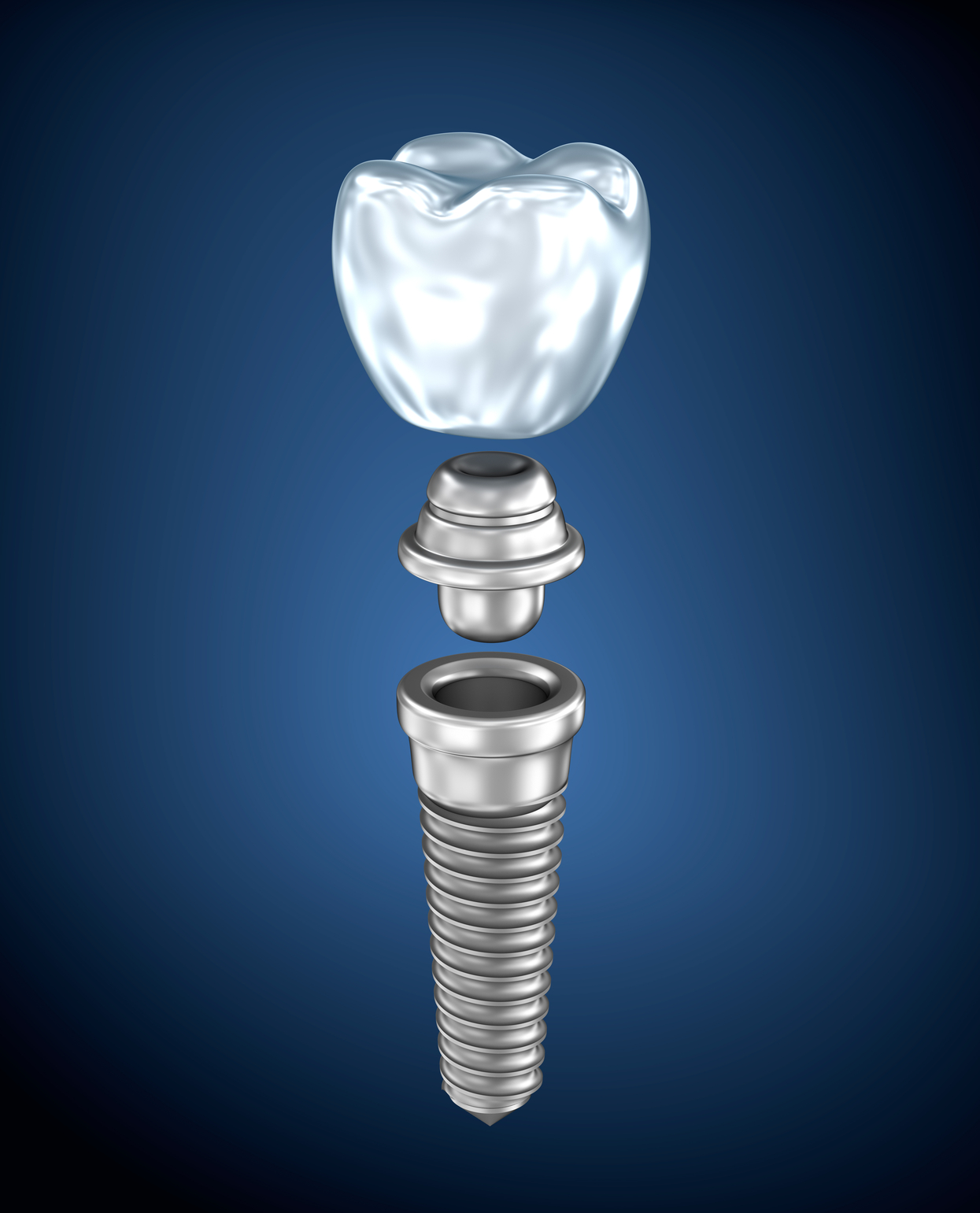 dental-titanium-implant-weldon-dentistry-blog