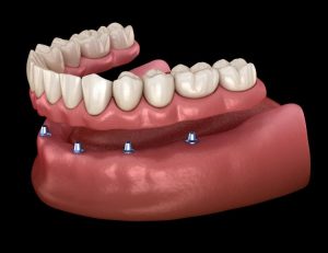 Can I Replace All My Teeth? Yes! A Dentist Explains Two Different Options