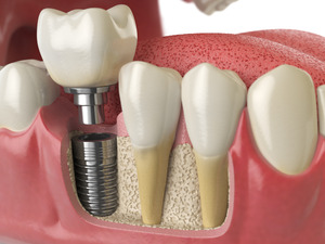 Image of a dental implant